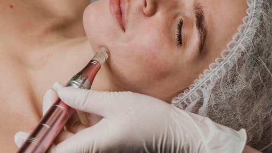 Microneedling for Acne: A Natural Technique to Boost Collagen and Skin Renewal